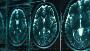 Lesiones Ocultas Después de un Accidente Automovilístico - Lesión Cerebral