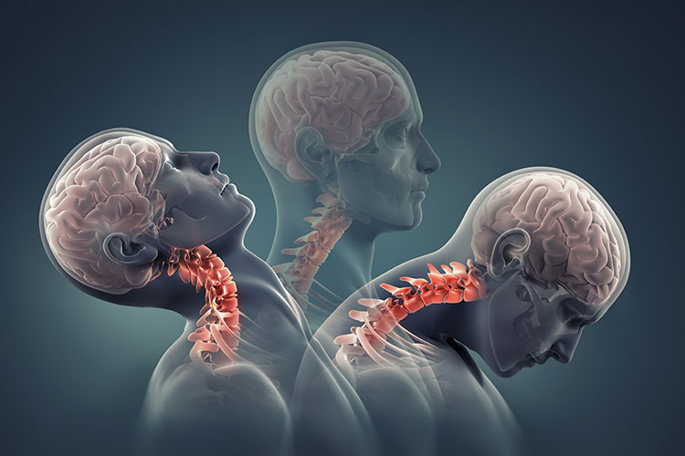 whiplash injury