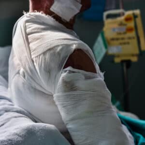 burn-injury-300x300 - Amarillo personal injury lawyers