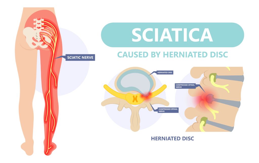 Sciatica nerve pain lower back through hips to leg